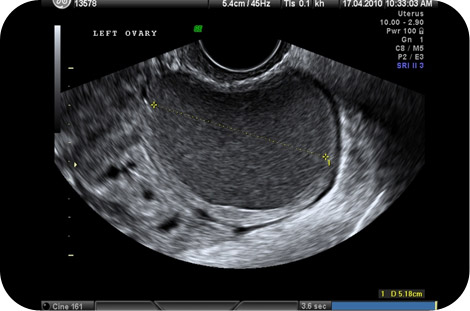 Can an ultrasound show the size of a cyst?